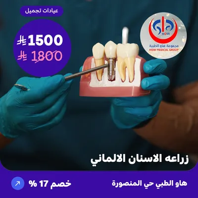 ( زراعة الاسنان الالمانية العرض على سن واحد ) لدى هاو الطبي حي المنصورة